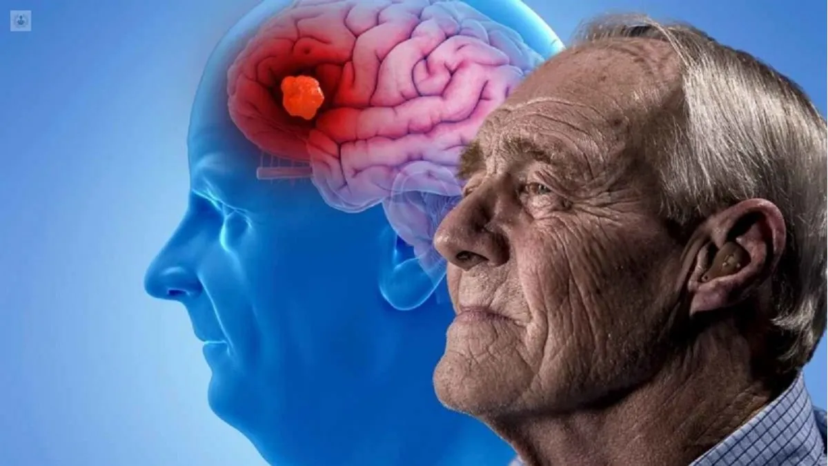 alzheimer1jpg